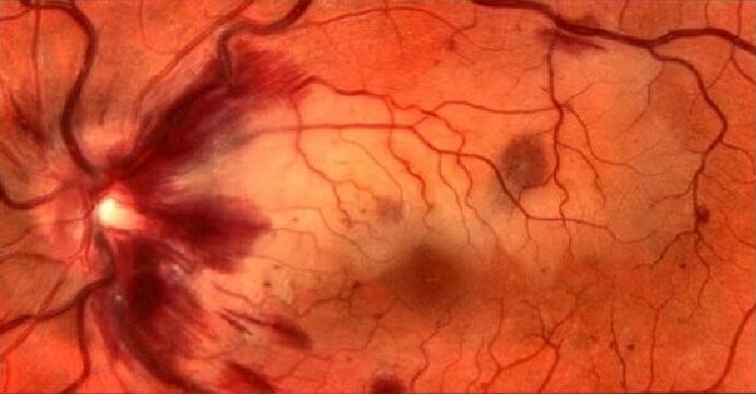 A retina véredényei és a látás helyreállítása